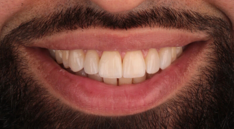 after 01 - Floss Lincoln Park