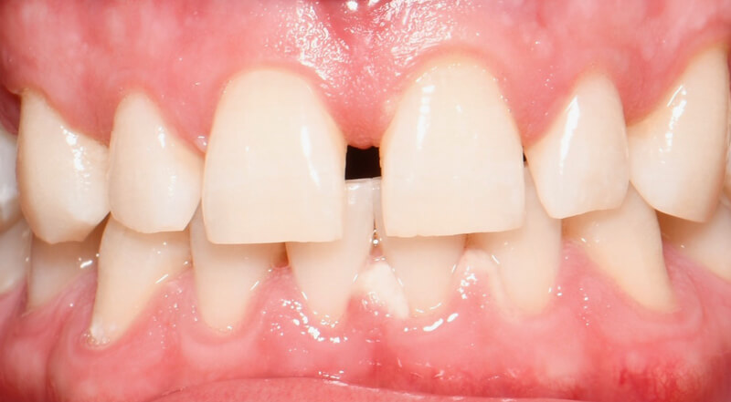 before 02 - Floss Lincoln Park