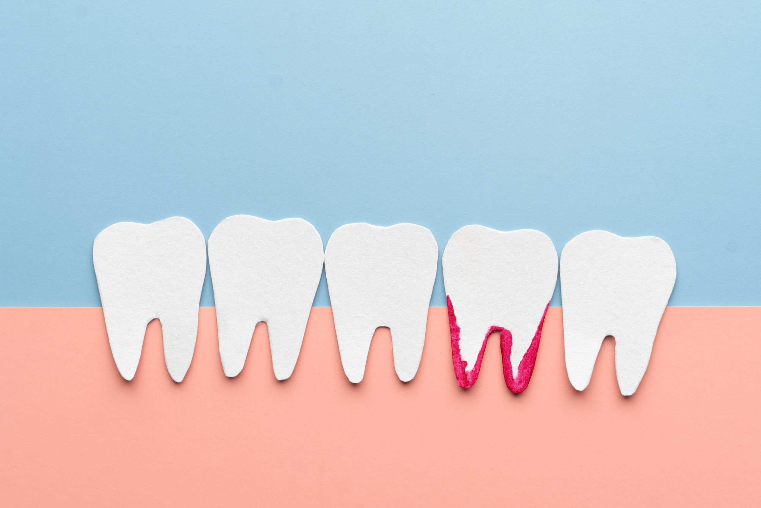 White teeth bleeding cartoon made from paper. Bleeding gums are a sign of gingivitis, periodontitis or vitamin deficiency. Dental health care concept.