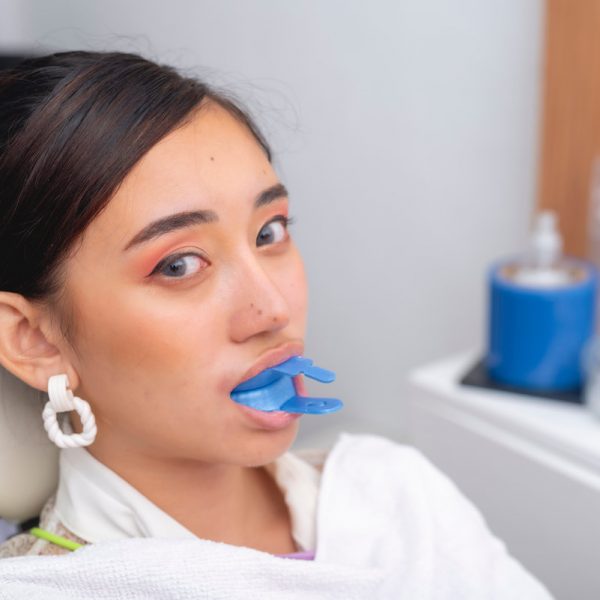 A female patient biting down on a blue fluoride gel foam tray in her mouth. Used for applying fluoride gel to strengthen teeth and prevent cavities during a dental treatment.
